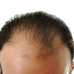 Vypadávanie vlasov - príčiny, príznaky, liečba