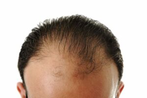 Vypadávanie vlasov - príčiny, príznaky, liečba