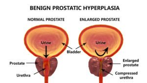 Benígna prostatická hyperplázia