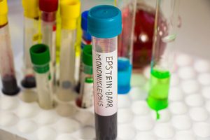 skúmavka so vzorkou krvi s označením EBV vírus